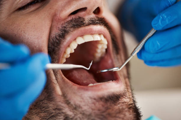 Best Emergency Dentist for Lost Fillings or Crowns in Paulsboro, NJ